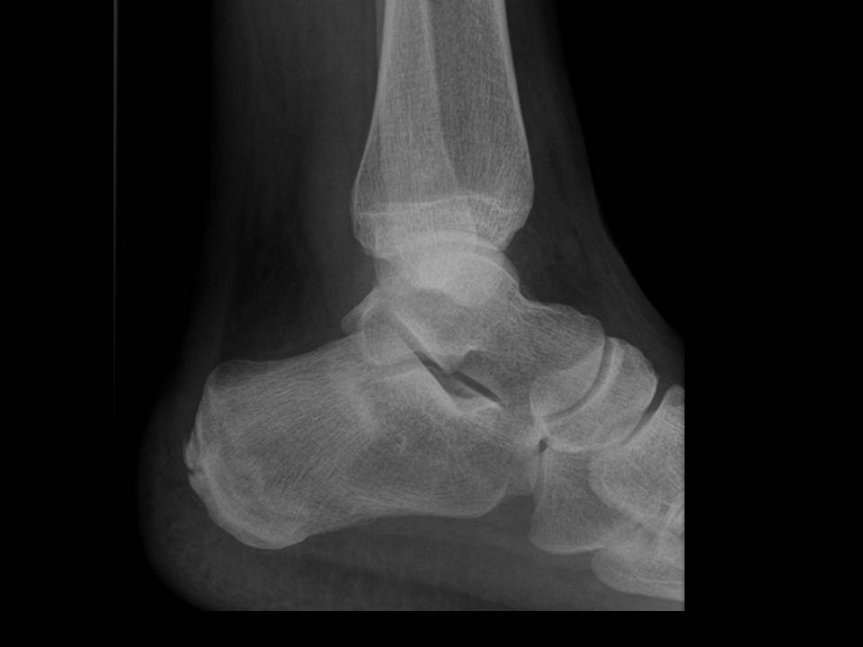 Calcaneus Fractures Trauma Orthobullets